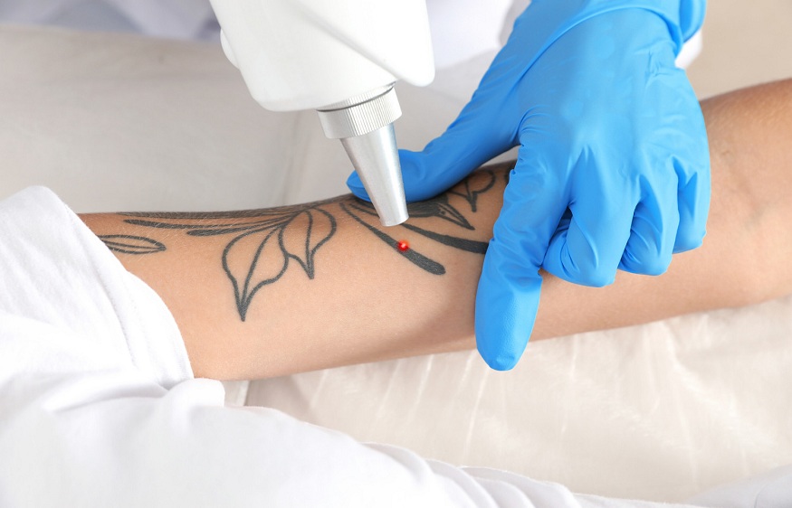 A Guide to Tattoo Removal Machine Training