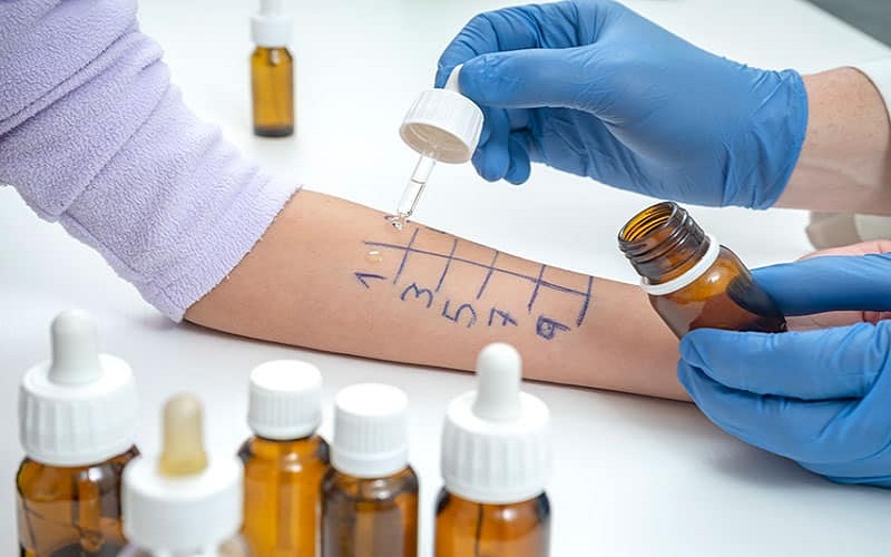 allergy testing New Jersey